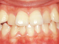 歯列矯正サンプル